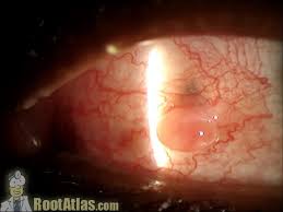 Image result for Pyogenic Granuloma