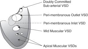 Ventricular Septal Defects Chapter 9 Core Topics In