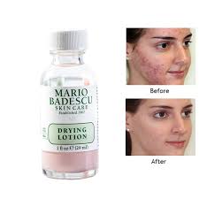 This Miraculous Lotion Will Dry Up All Your Juicy Pimples Asap