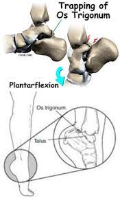 Minimally Invasive Os Trigonum Excision Orthovirginia