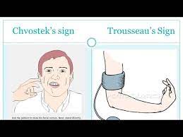 It refers to an abnormal reaction to the. Trousseau S Sign Of Latent Tetany Youtube
