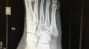 A jones fracture is a break involving the base of the 5th metatarsal bone. 11 Tips For Healing A Broken Bone Faster By Colin Keeley Medium