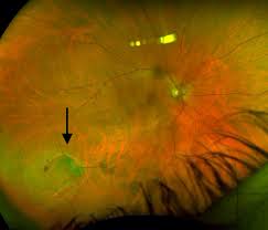 Visual disturbances develop in one eye, and a headache starts at the same time or within an hour. Retinal Tears And Detachments