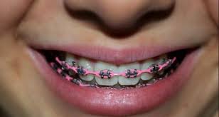 Light Pink Power Chain Braces Pink Braces Dental Braces Dental Braces Colors Pink Braces