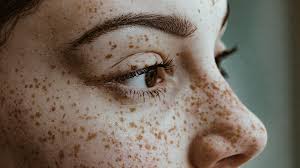 Image result for Freckled skin
