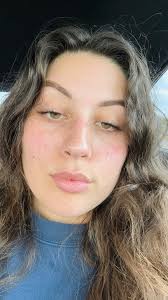 Central Heterochromia