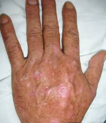 Hepatitis b, hepatitis c, and hepatitis d spread through contact with the blood of someone who has the disease. Atrophic Rash In A Hepatitis C Patient Clinical Advisor