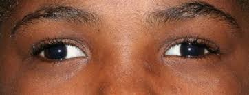 Image result for Strabismus