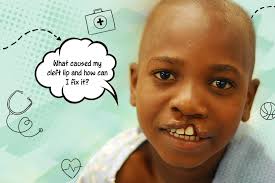 Image result for Cleft Lip