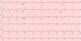Image result for Transcutaneous Pacing
