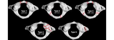 We did not find results for: Gehweiler Classification Of Atlas Fractures 4 Type 1 Fractures Of Download Scientific Diagram