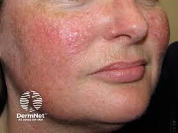 Image result for red rash face