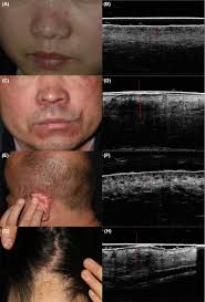 Investigation of using very high‐frequency ultrasound in the differential  diagnosis of early‐stage pemphigus vulgaris vs seborrheic dermatitis