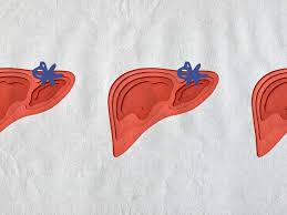 Image result for Liver Function Test Abnormality