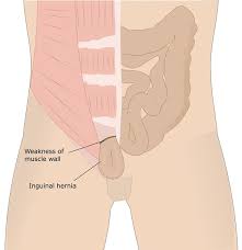 Groin muscles diagram anatomy of groin area photos muscles of the groin diagram human. Inguinal Hernias In Children