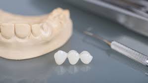 The concept is similar to that of a typical dental bridge in that the dentist will attach the prosthetic tooth replacement to teeth on either side of the gap to create a seamless smile. Dental Bridge For Front Teeth Vs The Molars Victoria Tx Dr Rob Zboril