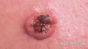 If you have a spot that scabs and crusts over, but the sore is. What Does Skin Cancer Look Like Basal Cell Carcinoma Youtube
