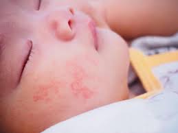 Human breast milk typically does not cause allergic reactions in breastfeeding infants, but mothers still, if your family has experienced severe food allergies, you might consider limiting your intake of milk and dairy products, fish, eggs, peanuts, and other nuts during pregnancy and while breastfeeding. Allergic Reaction In Baby Treatment And Pictures