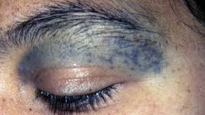 Image result for nevus sclerae