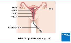 Hysteroscopy Procedure Health Information Bupa Uk