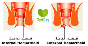 البواسير الأسباب الأعراض والعلاج طب تايم