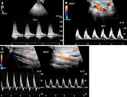 Bilateral Common Carotid Artery Common Trunk With Aberrant