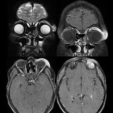 Image result for Dacryoadenitis