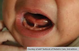 Image result for Ankyloglossia