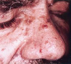 Muir Torre Syndrome Confirmation Of Diagnosis By Immunohistochemical Analysis Of Cutaneous Lesions Journal Of The American Academy Of Dermatology