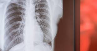 Image result for lung cancer xray
