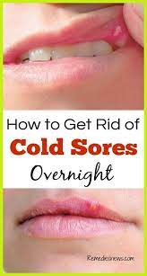 How To Get Rid Of A Cold Sore Overnight Without Medicine Cold Sores Remedies Cold Sore Cold Home Remedies