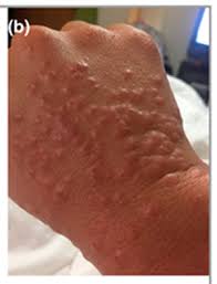 Herpes zoster o culebrilla o zoster; En La Piel Tambien Se Reflejan Sintomas De Covid 19 Revista Pesquisa Javeriana