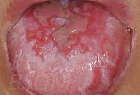 Image result for lichen planus on tongue)