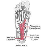 Plantar Fasciitis Runner S World Massage Therapy Sports Massage Body Health