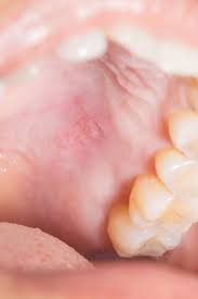 What causes small white bumps on roof of mouth? Bump On The Roof Of The Mouth 12 Causes