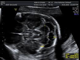 Die feindiagnostik in der schwangerschaft ist die untersuchung des feten mit hilfe von hochauflösenden ultraschallgeräten. Feindiagnostik