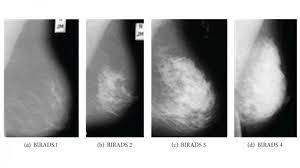 In this mammogram image, the breast calcifications are in ductal patterns. Mammogram Images Normal Abnormal And Breast Cancer