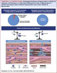 Active myocarditis in the spectrum of acute dilated. Pathological Evidence For Sars Cov 2 As A Cause Of Myocarditis Journal Of The American College Of Cardiology X Mol