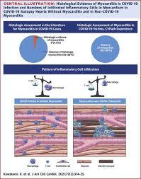 Myocarditis is clinically and pathologically defined as inflammation of the myocardium in the absence of the predominant acute or chronic ischaemia characteristic of coronary artery disease. Pathological Evidence For Sars Cov 2 As A Cause Of Myocarditis Journal Of The American College Of Cardiology X Mol