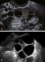 Check spelling or type a new query. Normal Pelvic Ultrasound And Common Normal Variants Clinical Gate