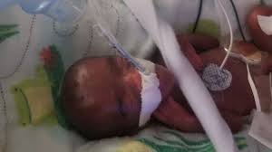 However, there are premature babies who gain weight rapidly in the first months and catch up in weight by the first year. World S Smallest Surviving Premature Baby Released From Us Hospital Bbc News