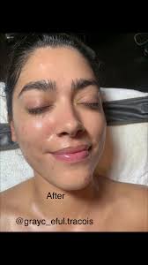 Nanoinfusion allows for specific serums to be infused into the dermis ...