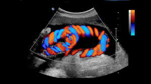 Renkli Doppler Nedir Renkli Doppler Fiyatlari 2020