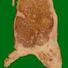 Cancer has spread into one or both of the diaphragm muscle and lung. 1
