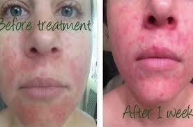 Sie suchen den besten sale? Woman Claims That Using Raw Honey Cleared Her Acne In Just Four Weeks