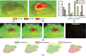 Small surgical instruments and a video camera are put into the. Image Guided Raman Spectroscopy Probe Tracking For Tumor Margin Delineation
