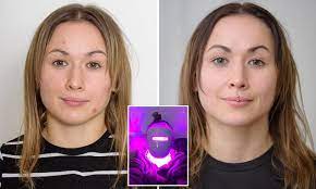 Led light therapy is a treatment used to rejuvenate skin. London Woman Tests Out Light Therapy Mask To Treat Acne Daily Mail Online