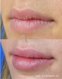 Feb 01, 2022 · uf health plastic surgery and aesthetics center department of surgery in the college of medicine request an appointment: Lip Injections Orlando Fl High Quality Lip Fillers Aesthetic Lane