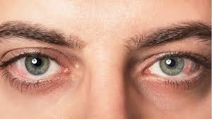 Image result for Allergic Conjunctivitis