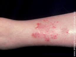 Dermatitisstasis 2 Jpg 560 420 Pixels Stasis Dermatitis Atopic Dermatitis Psoriasis Treatment